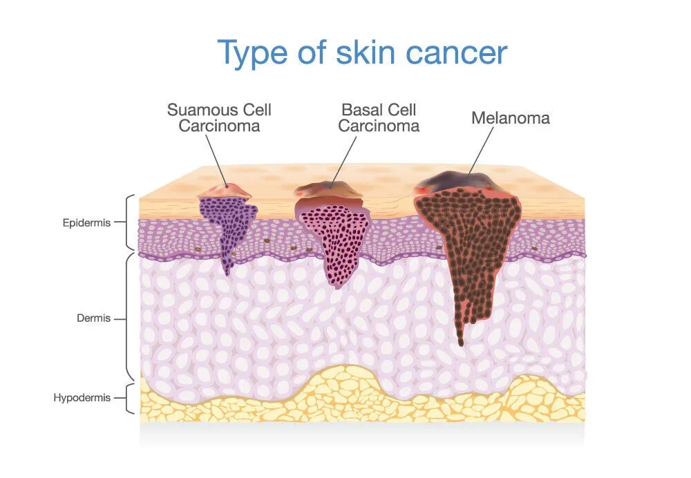 vulvar melanoma