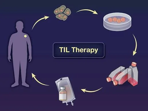 stage 4 melanoma