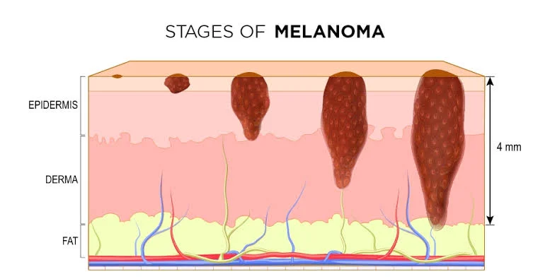  Natural Ways to Complement Melanoma Treatments Effectively