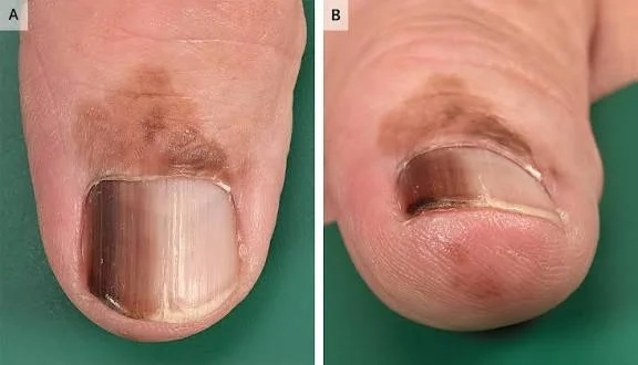 nail melanoma