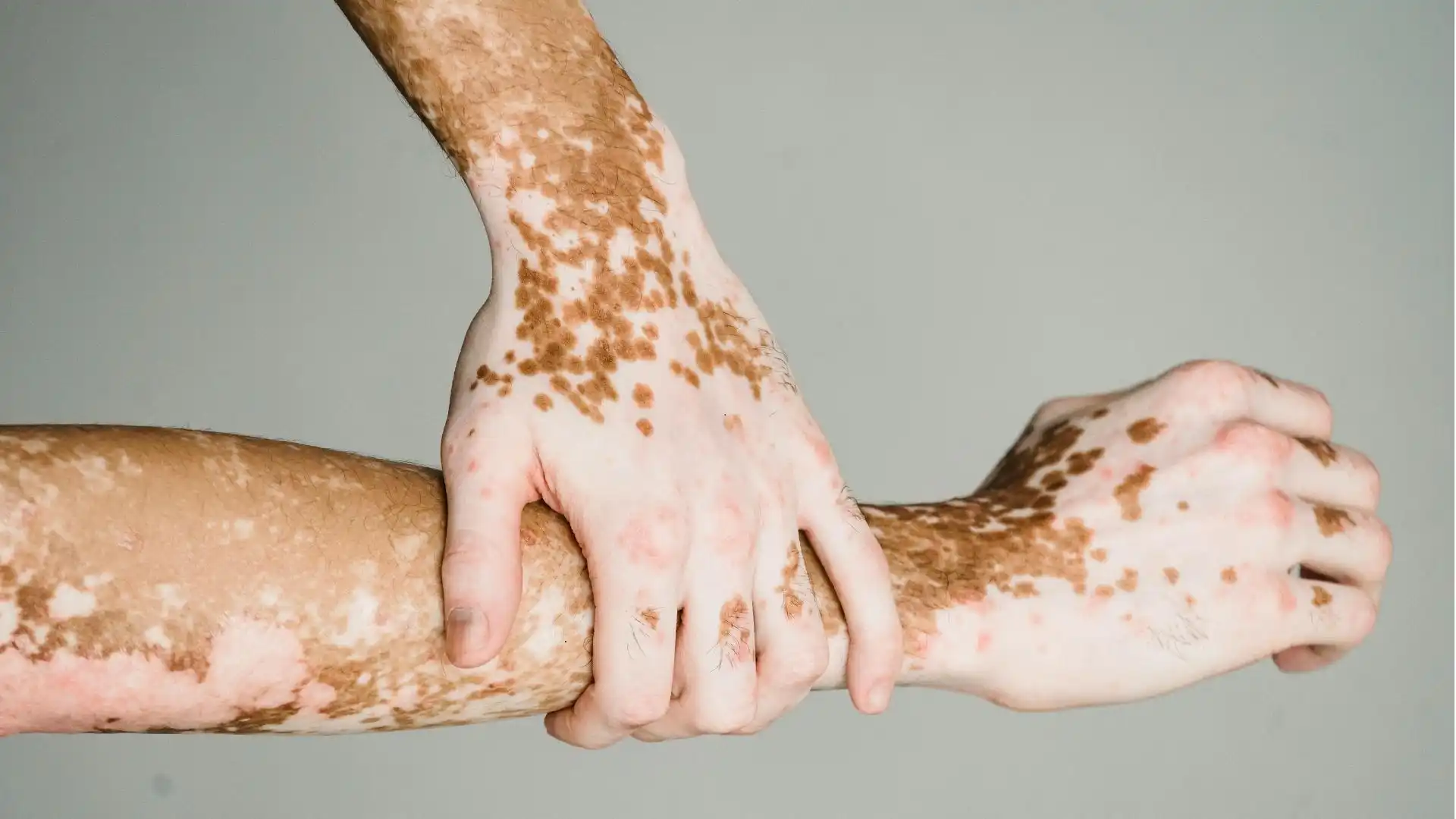 melanoma cancer white spots on skin