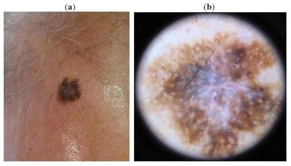  Melanoma on Scalp: Risk Factors & Prevention Strategies
