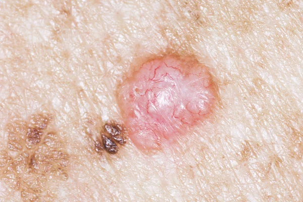 what does melanoma look like on the skin