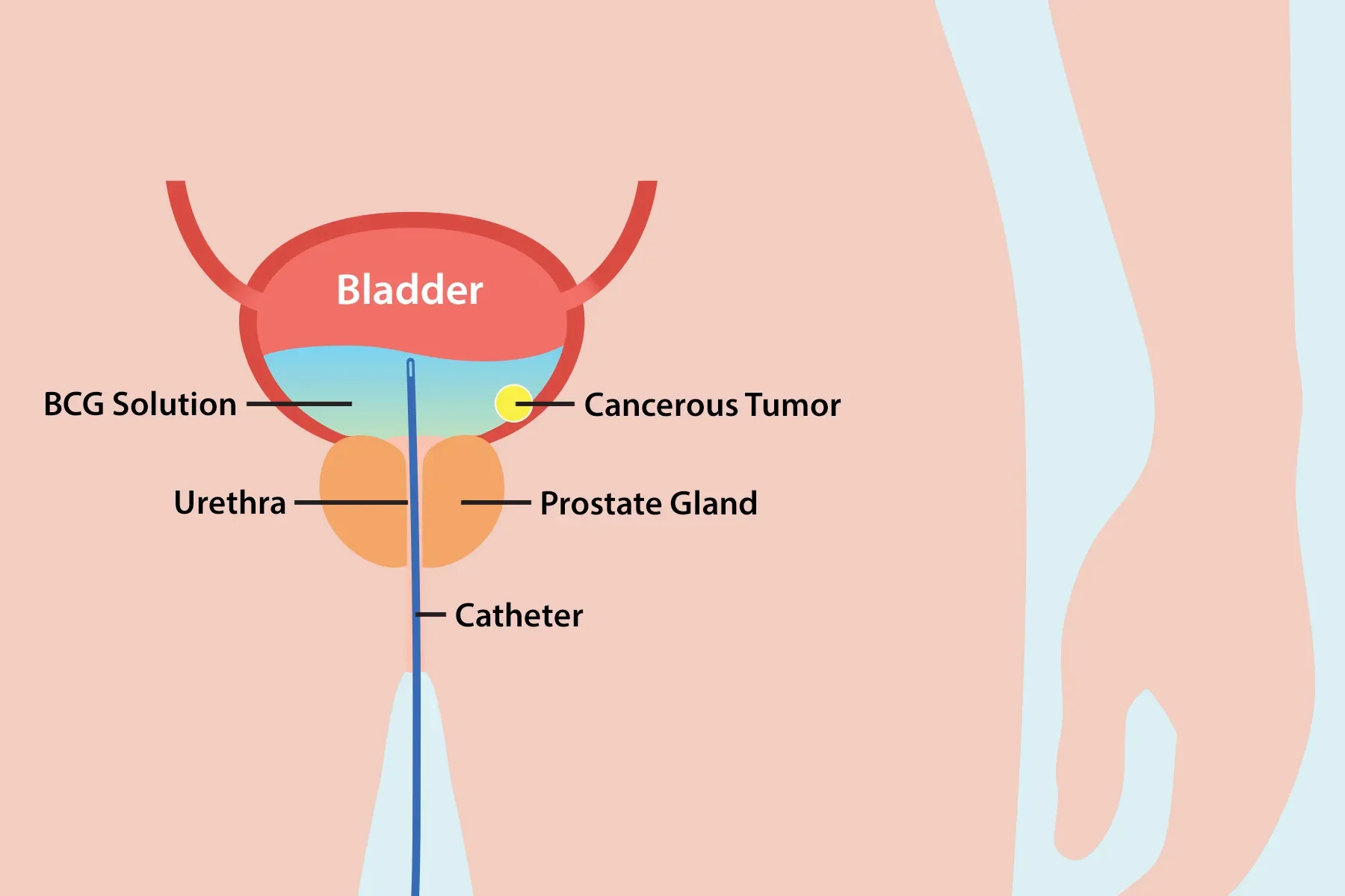 immunotherapy for bladder cancer