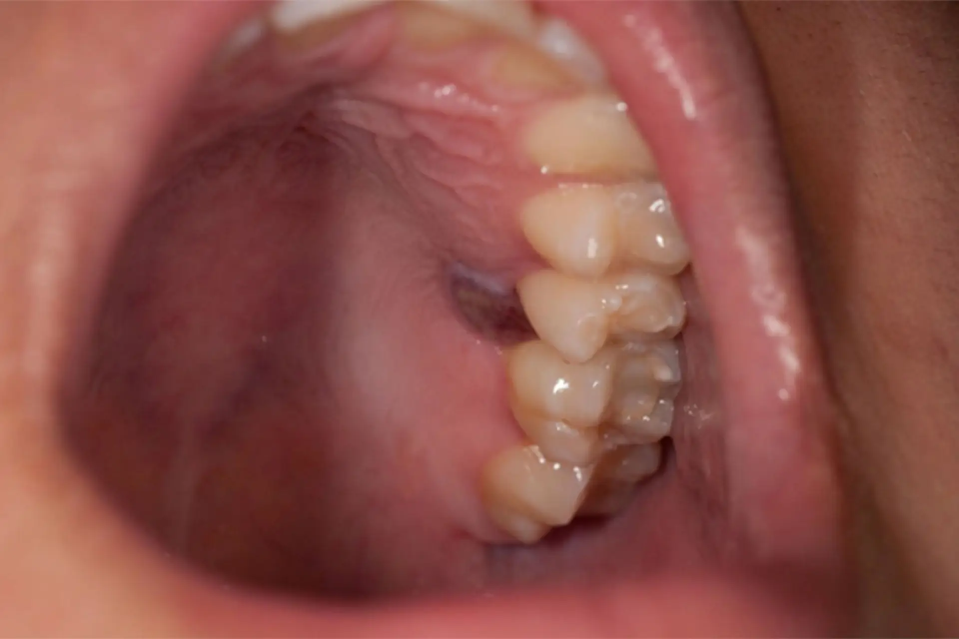 mucosal melanoma