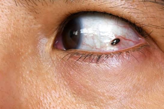 signs of melanoma