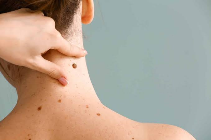  What Does Melanoma Look Like on the Skin? Key Visual Clues