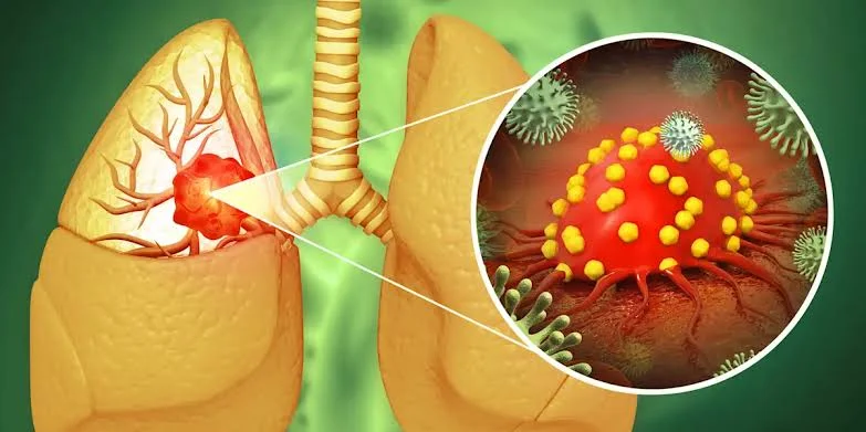 stage 4 lung cancer immunotherapy life expectancy