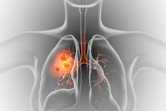 stage 4 lung cancer immunotherapy life expectancy